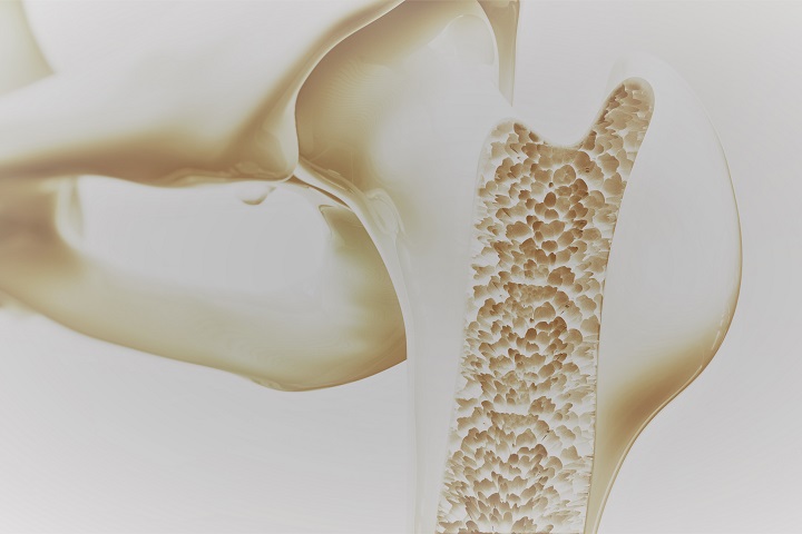 Csontritkulás (osteoporosis)