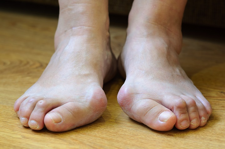 Fájdalmas lábujj jelent meg a lábujjai között)